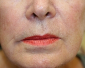 Feel Beautiful - Hyaluronan gel (Expression) around lips - After Photo